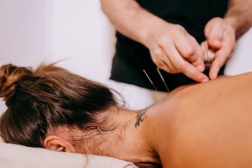 Acupuncture Acupuncture